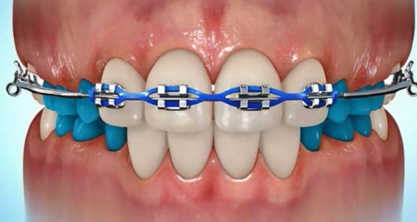 Expanding Appliances and Partial Braces (2)