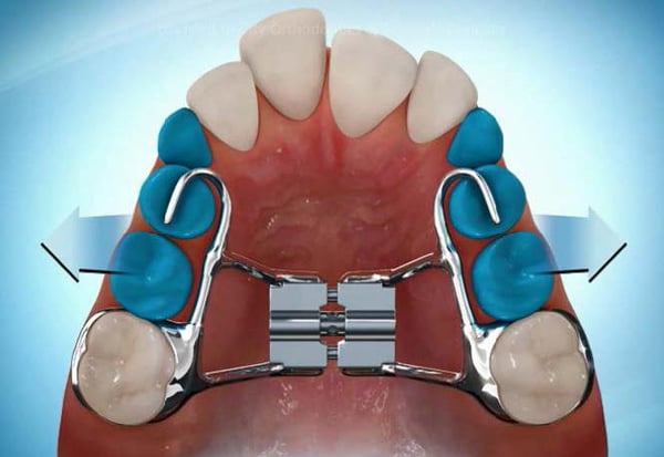 Expanding Appliances and Partial Braces