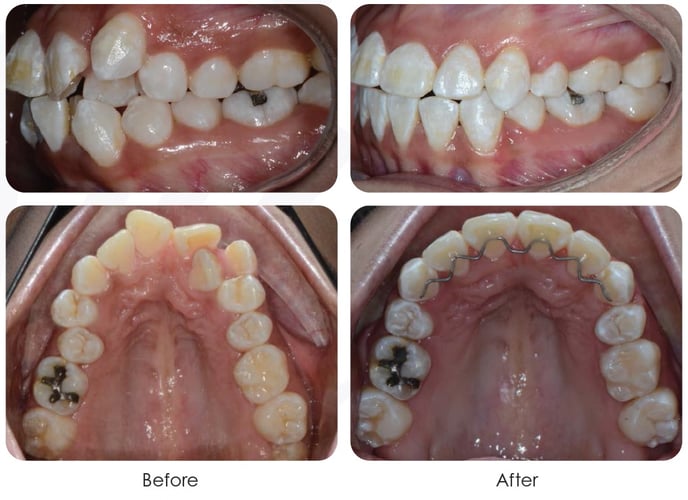 Extractions - Orthodontics