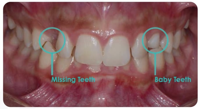 Impacted Teeth (2)