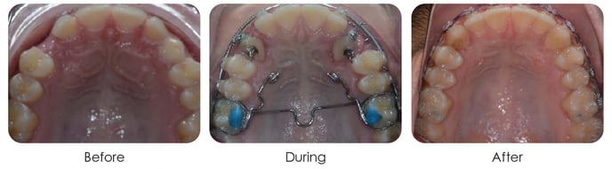 Impacted Teeth (3)