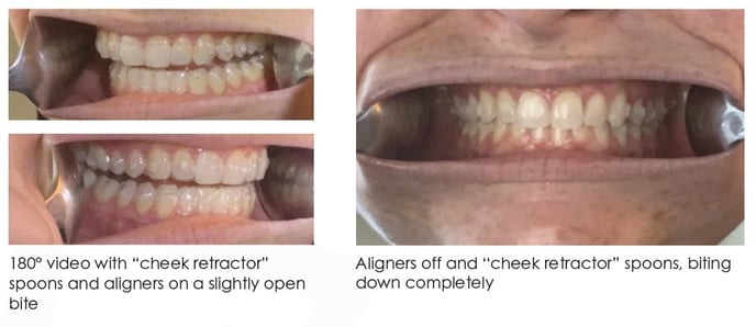 Invisalign Patient Remote Care (2)