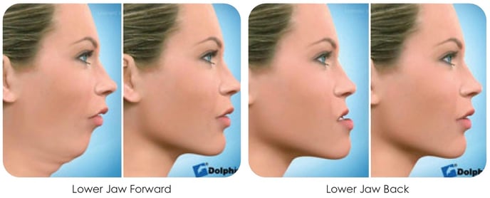 Jaw Surgery - Before and After