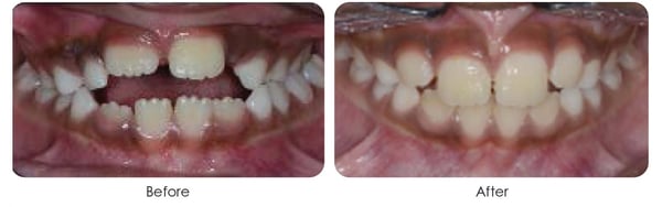 Tongue Thrust Appliance (2)