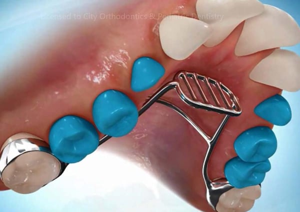 Tongue Thrust Appliance