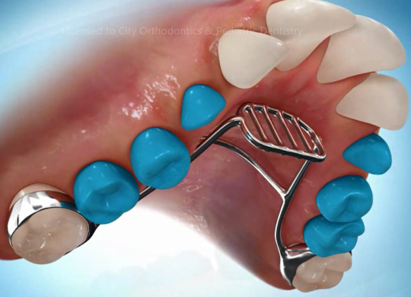 tongue thrust and crib appliance